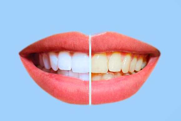 <font size="3" color="#000080">BLANQUEJAMENT DENTAL</font>