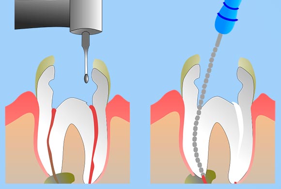 <font size="3" color="#000080">ENDODONCIA</font>