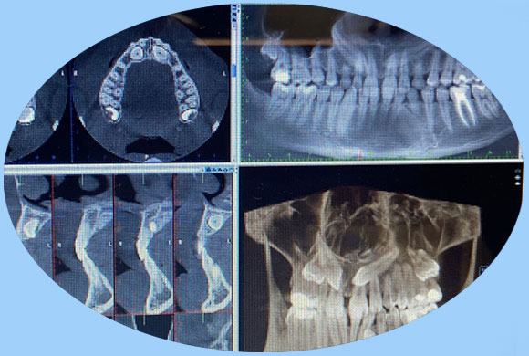 <font size="3" color="#FFFFFF">TAC 3D Odontològic </font>